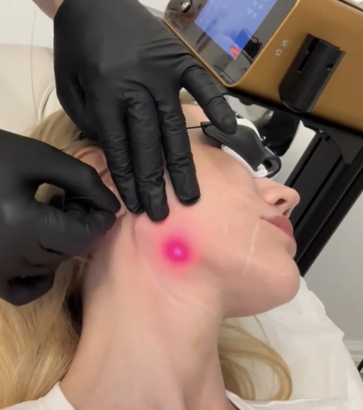 Dr. Mehmet Karakuyu Endolift Lazer uygulaması