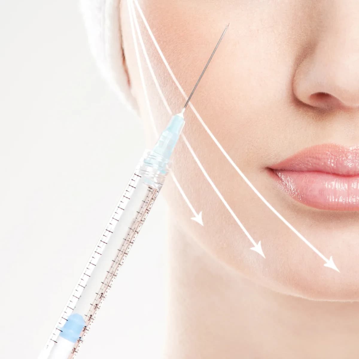 Dr. Mehmet Karakuyu Biyostimülan Tedavisi (CAHA, PLLA, PCL) uygulaması